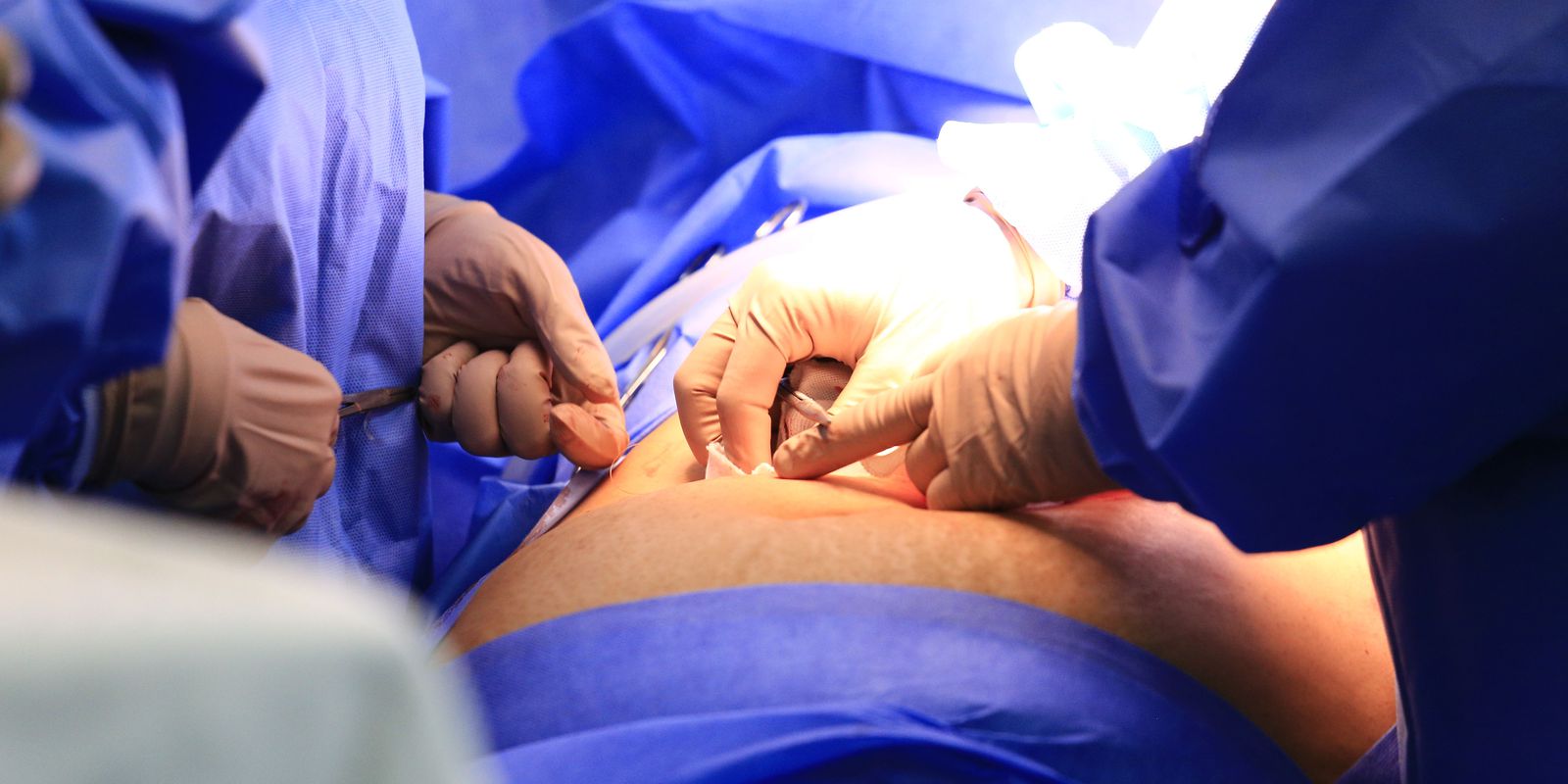 Privado: Varizes pélvicas, que atingem população feminina, podem ser tratadas