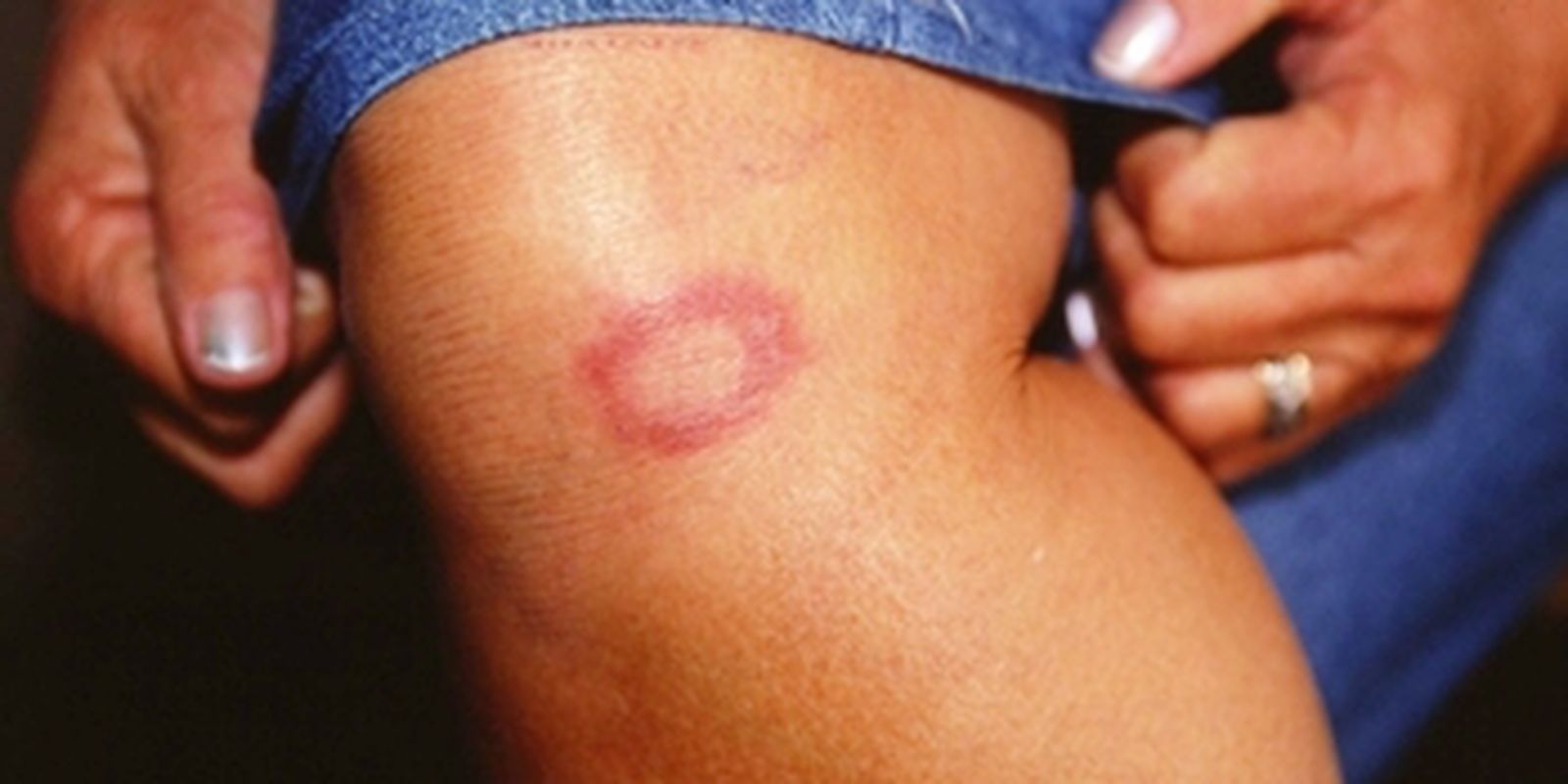 Privado: Hanseníase: marcas do preconceito é tema do Caminhos da Reportagem