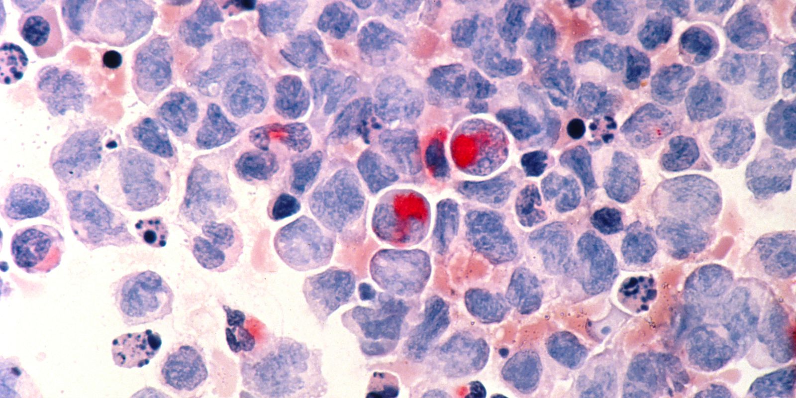 Privado: ANS inclui opções de quimioterapia oral em seu rol de procedimentos