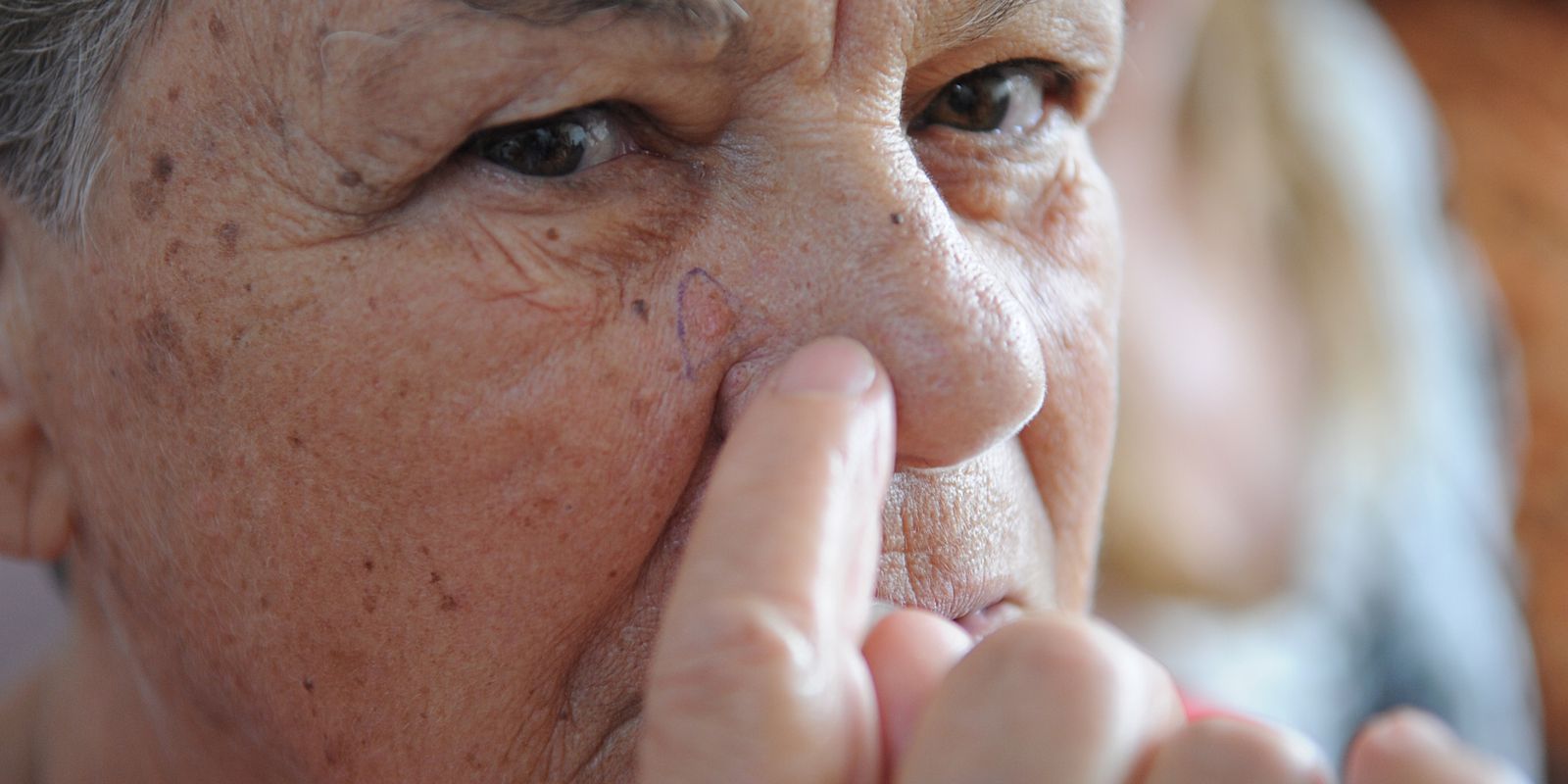 Privado: Ministério da Saúde abre consulta sobre diagnóstico do câncer de pele