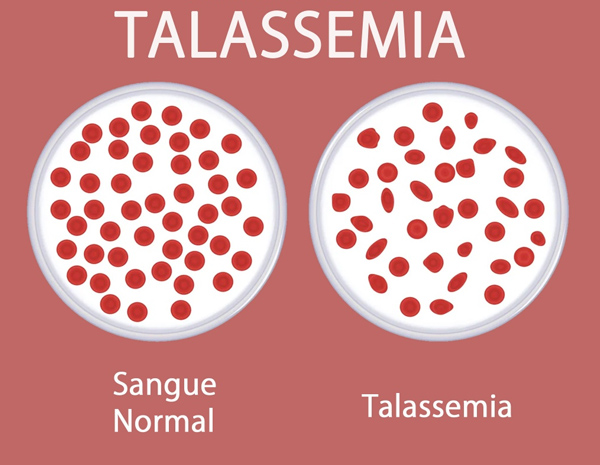Talassemia: doença rara e grave que todos devem conhecer