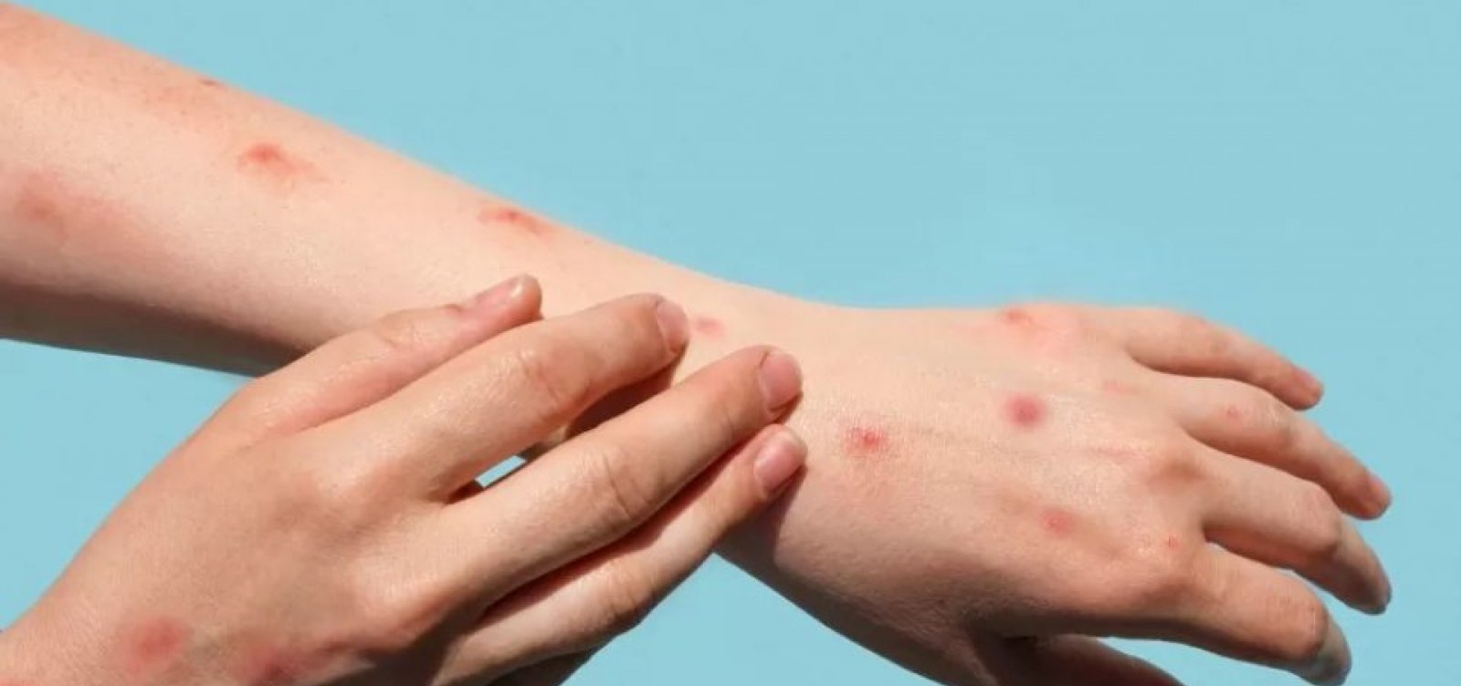 Paciente com varíola dos macacos no Rio tem sintomas leves