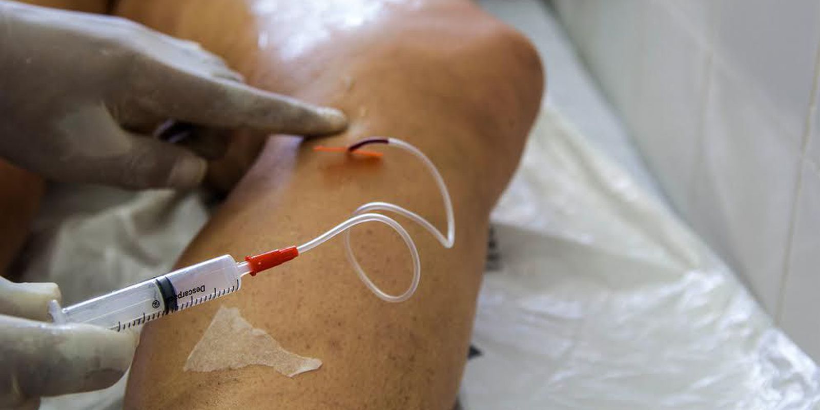 Privado: Doença venosa crônica é fator de risco para problemas cardiovasculares