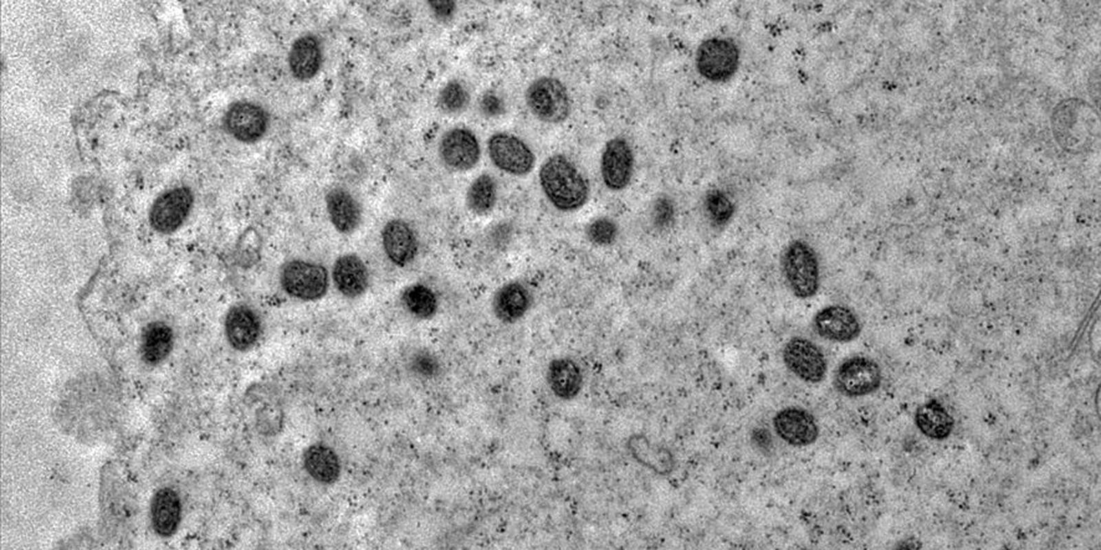 Privado: Minas Gerais tem segunda morte por varíola dos macacos confirmada