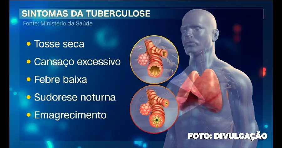 Tuberculose em São Gonçalo: Conscientização e prevenção