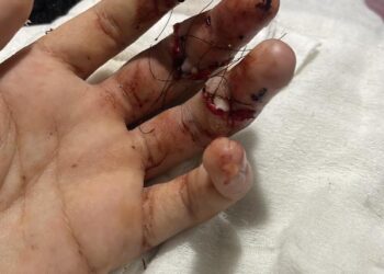 Abrasel Leste Fluminense-RJ exige segurança após ataque a jovem estagiário